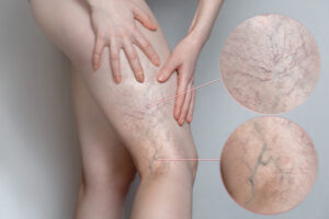 spider veins, varicose veins