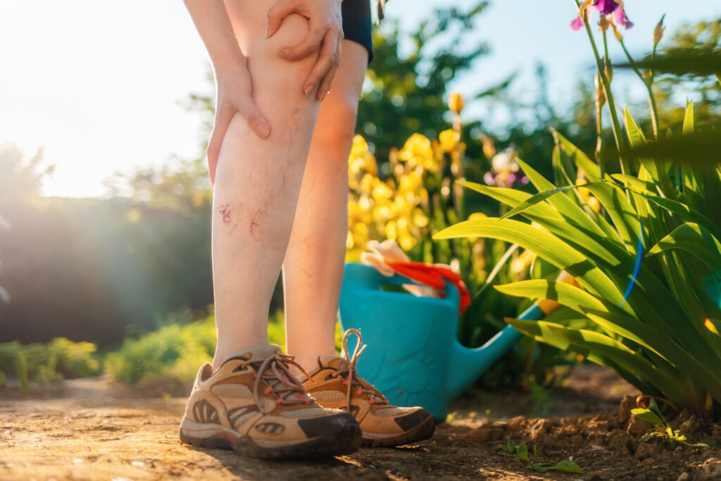 Varicose,Veins,And,Leg,Diseases.,A,Woman,Holds,Her,Hands