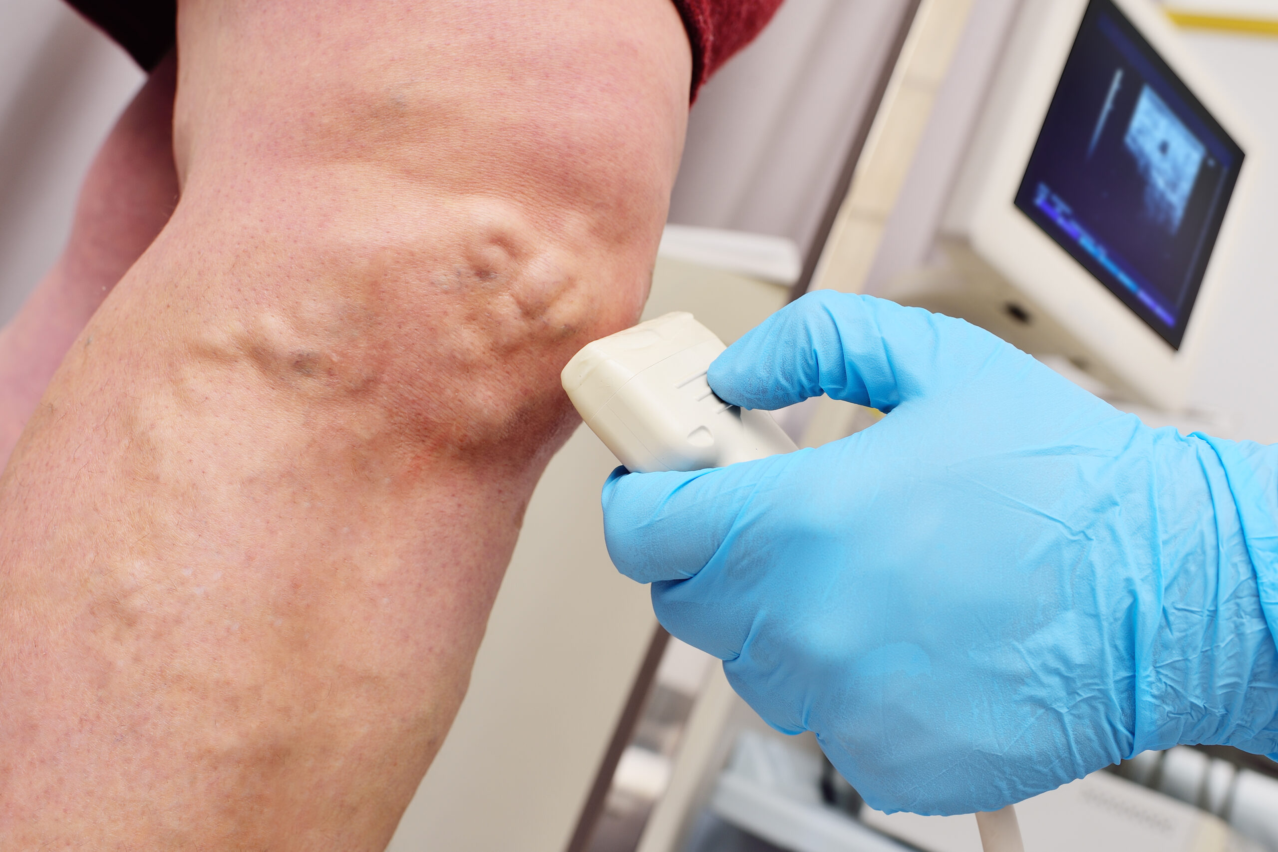 ultrasound scanning of a varicose vein