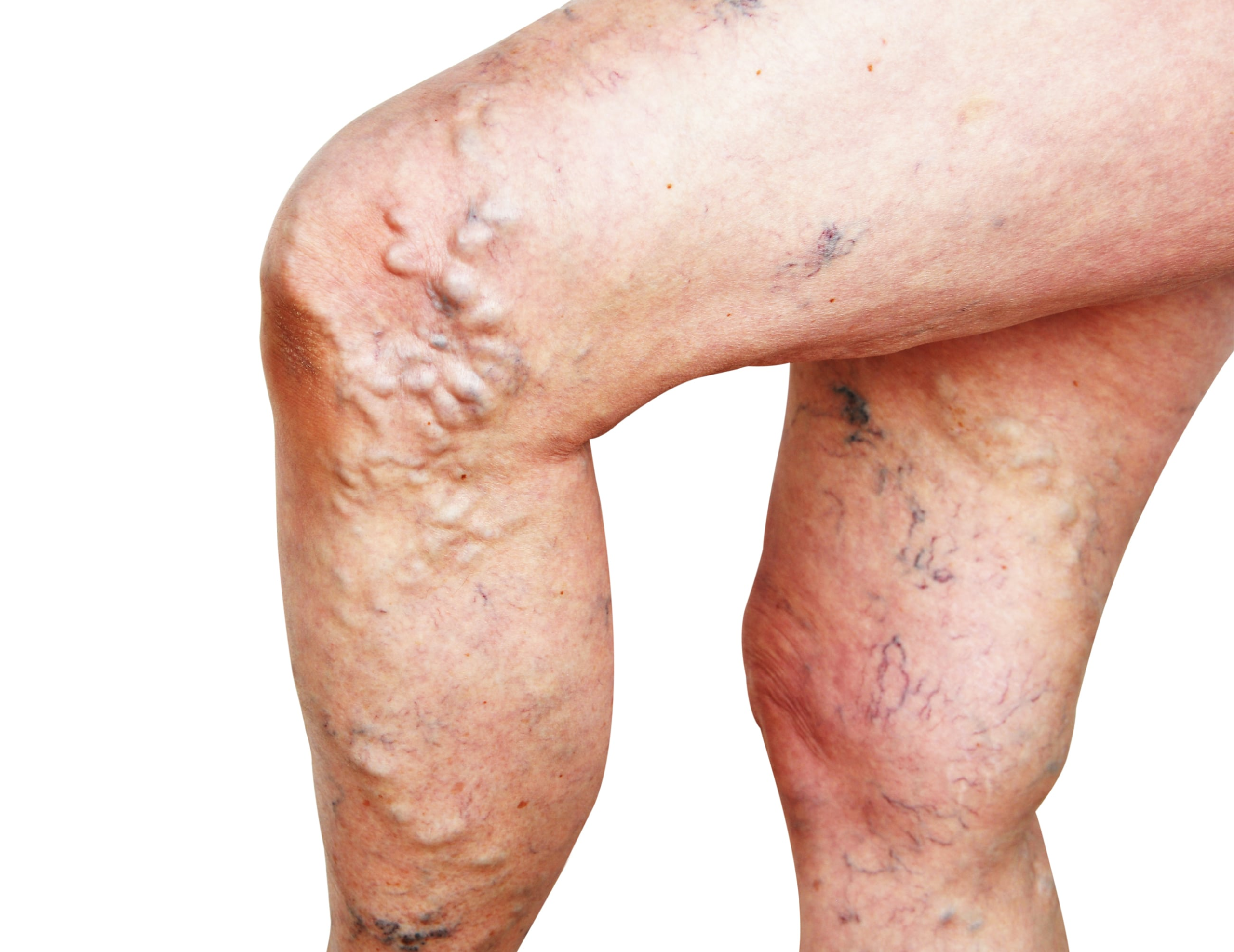 leg showing severe varicose veins