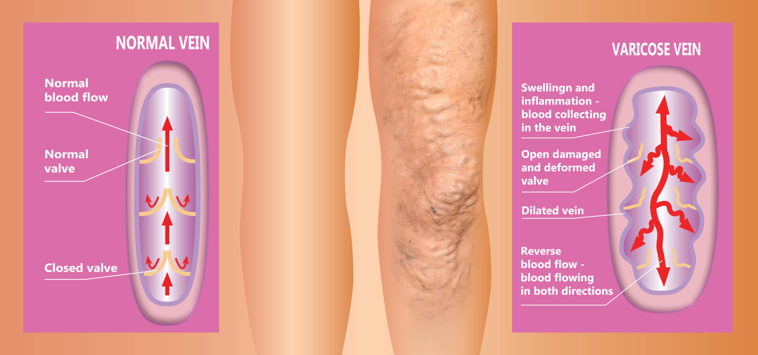 chart showing how varicose veins appear