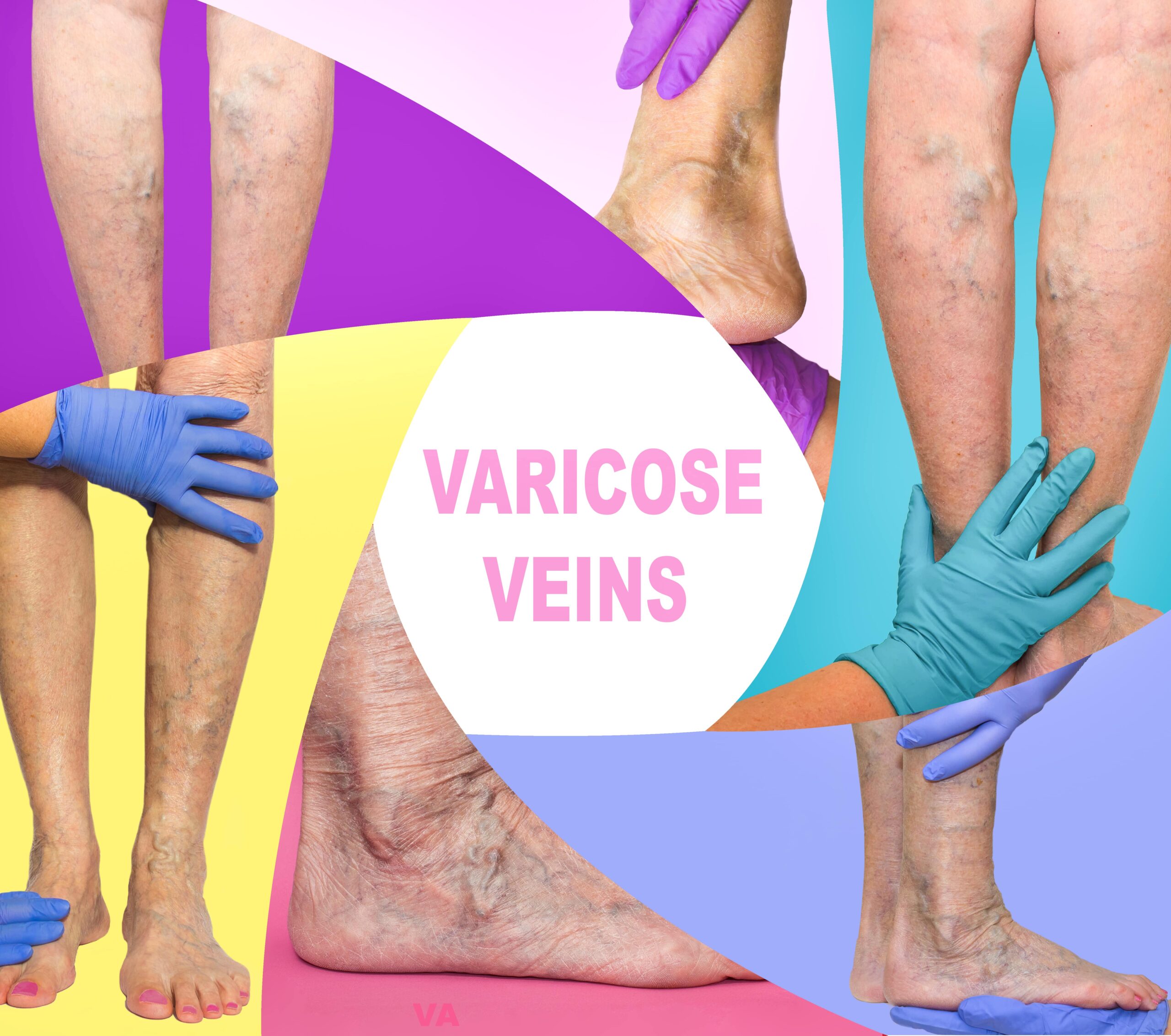 varicose veins and images showing their appearances