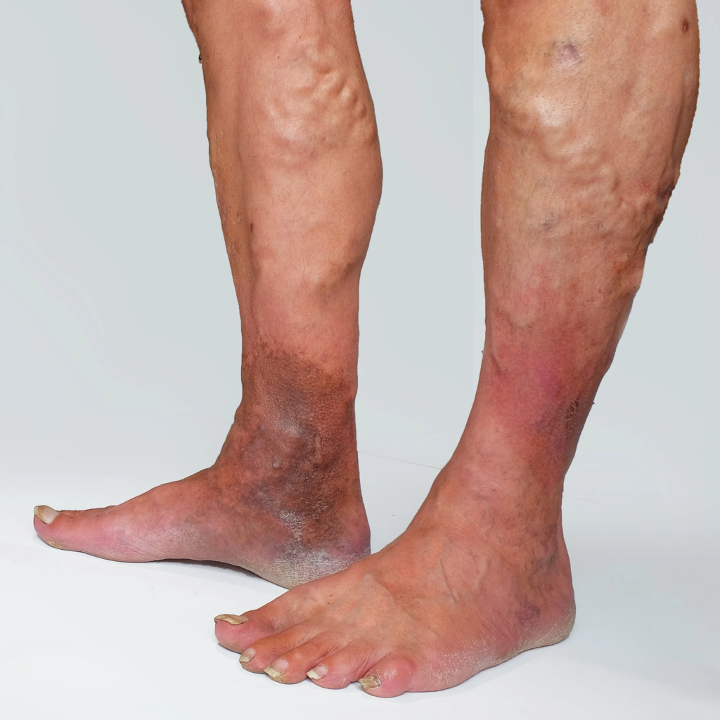 advance stage of varicose veins showing lipodermatosclerosis