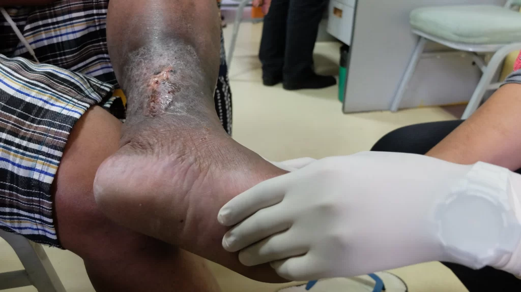 Doctor examining the leg of a patient with lipodermatosclerosis
