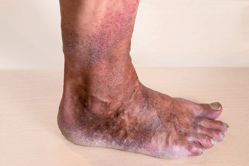 venous eczema on the ankle