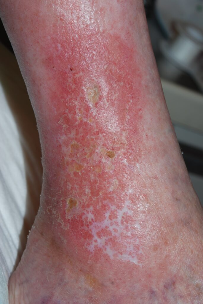 venous eczema with signs of lipodermatosclerosis