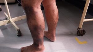 overweight patient showing skin changes due to chronic venous disease