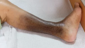 lower leg with hyperpigmentation and hardened skin