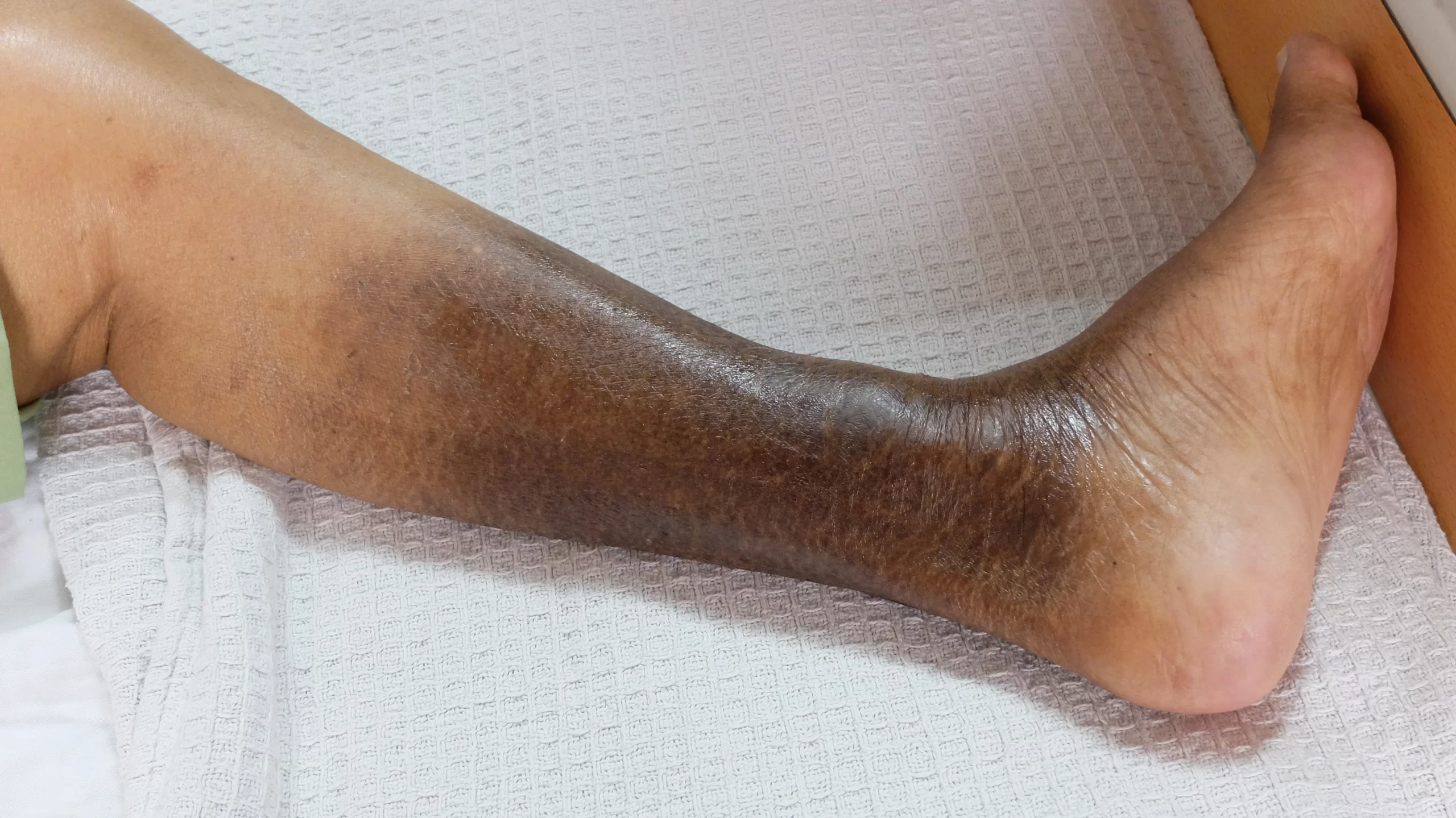 lower leg with hyperpigmentation and hardened skin