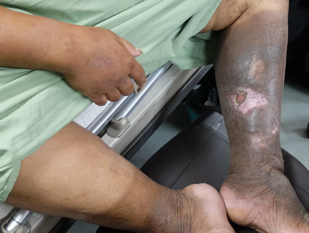 Leg with hyperpigmentation and ulcer