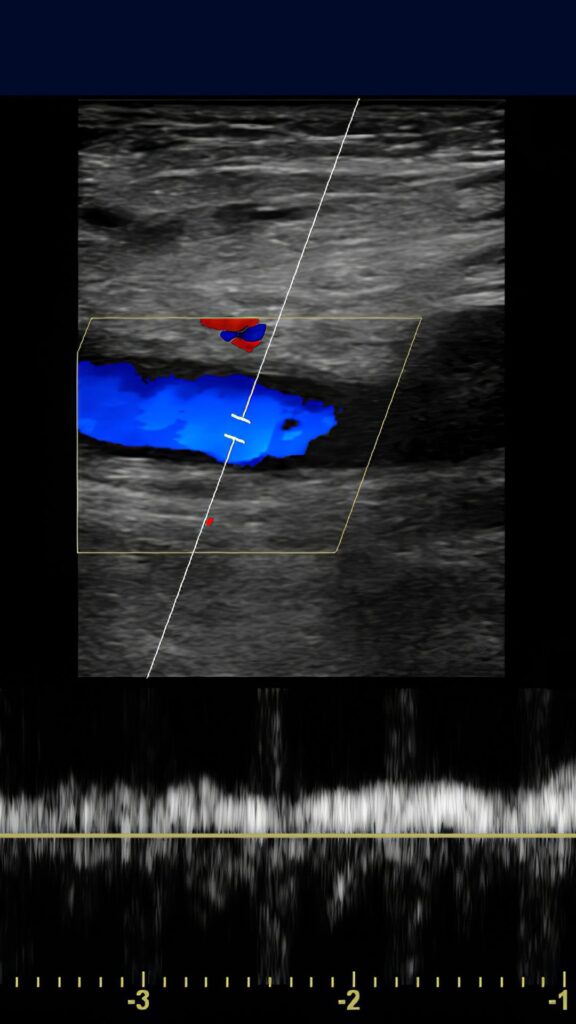 ultrasound image of a DVT