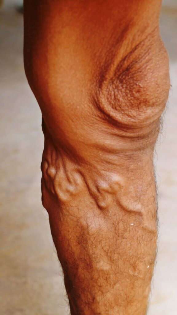 varicose veins lower leg of a man
