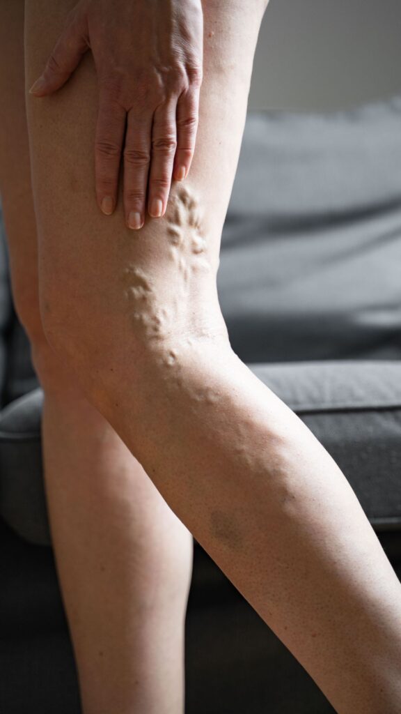 woman leg with varicose veins