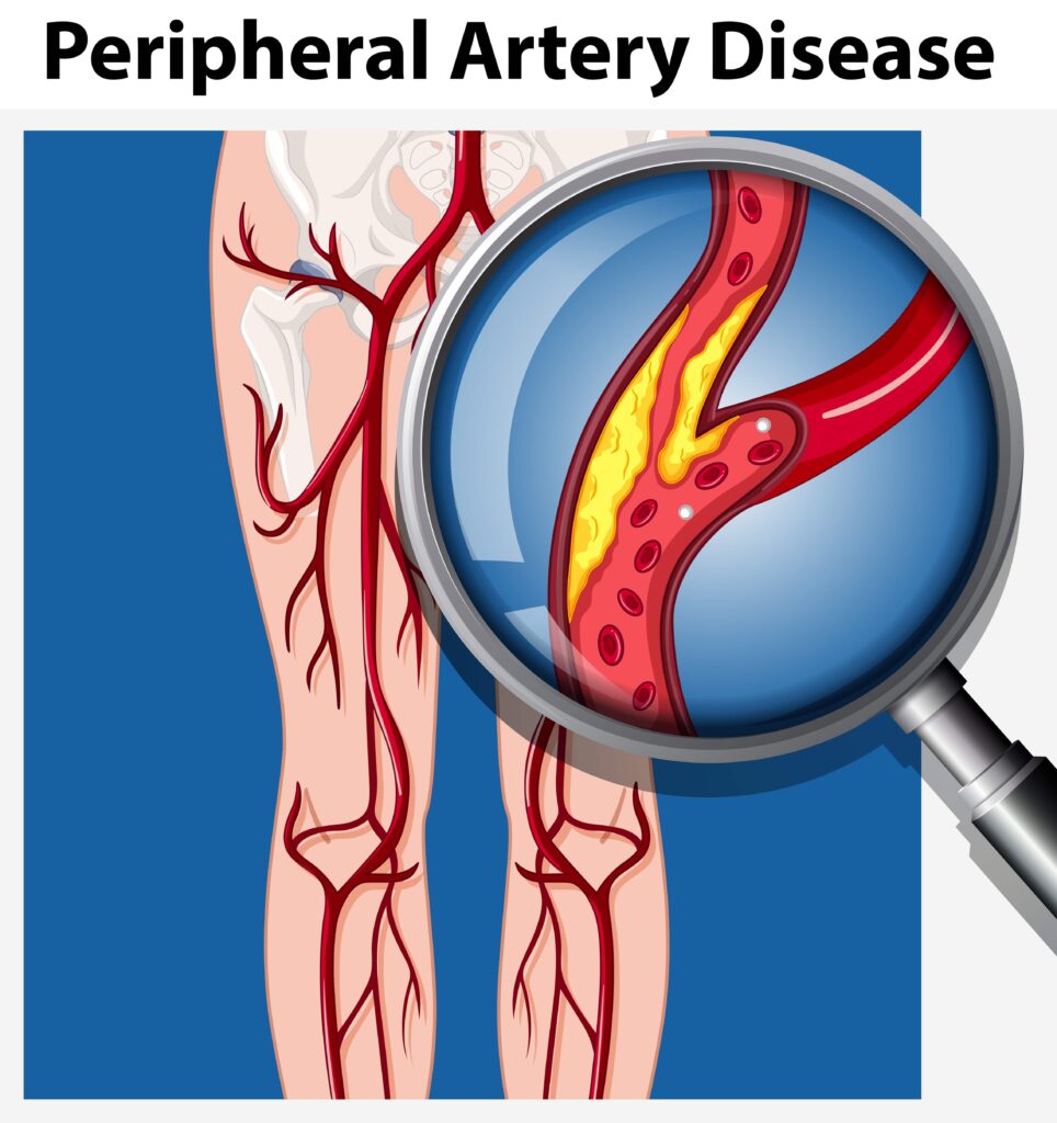 Human with Peripheral Artery Disease illustration