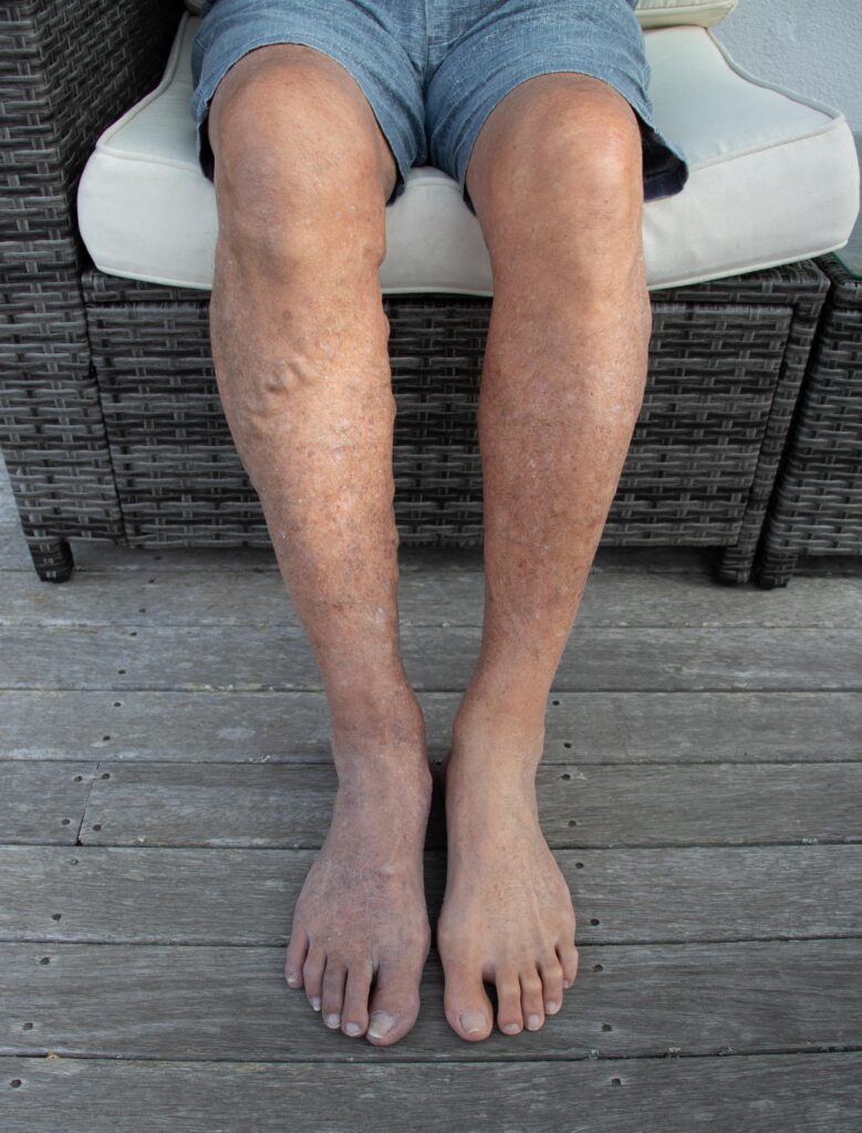elderly man sitting with bare legs showing varicose veins and poor circulation in feet