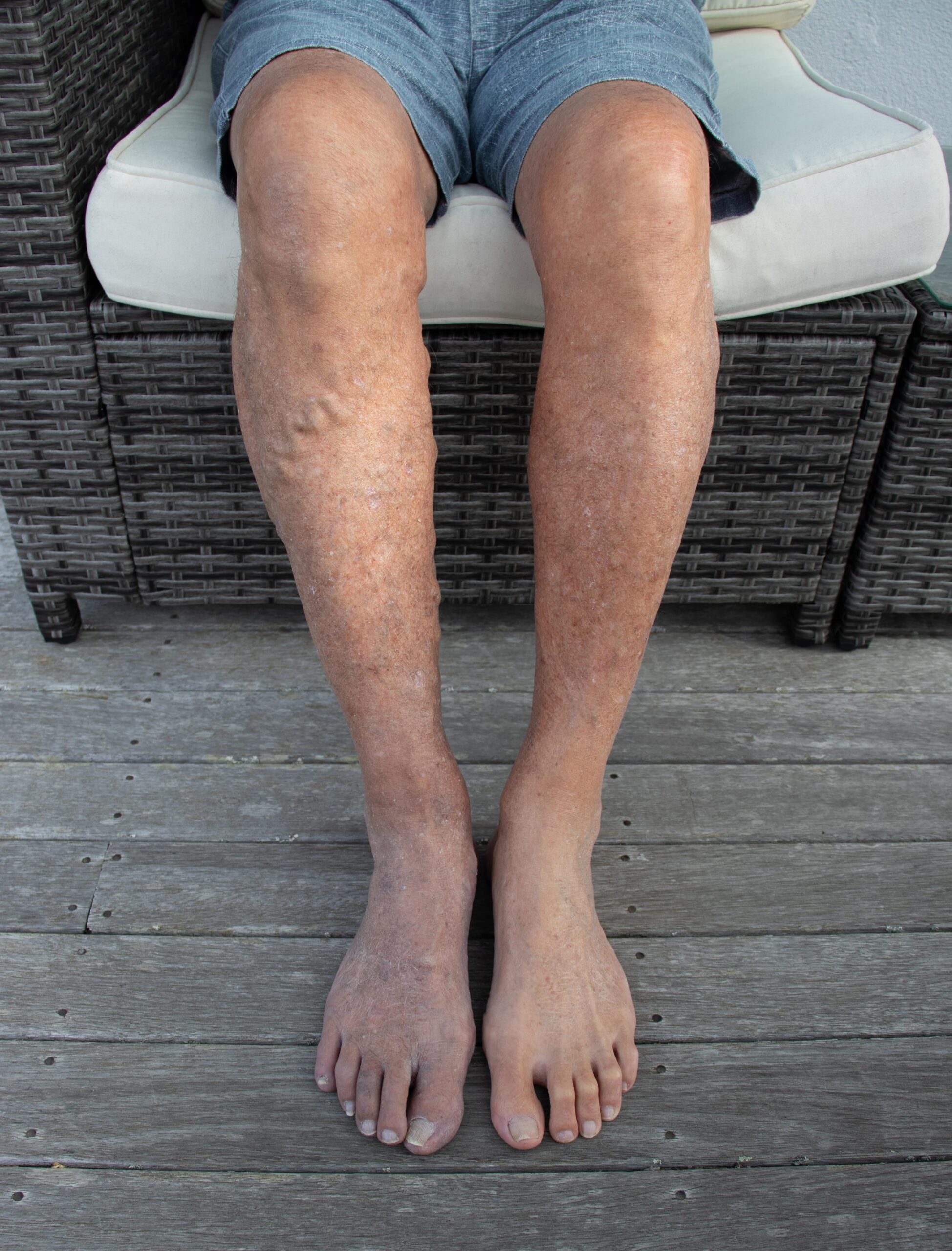 Poor circulation symptoms causes treatment laurel clinical