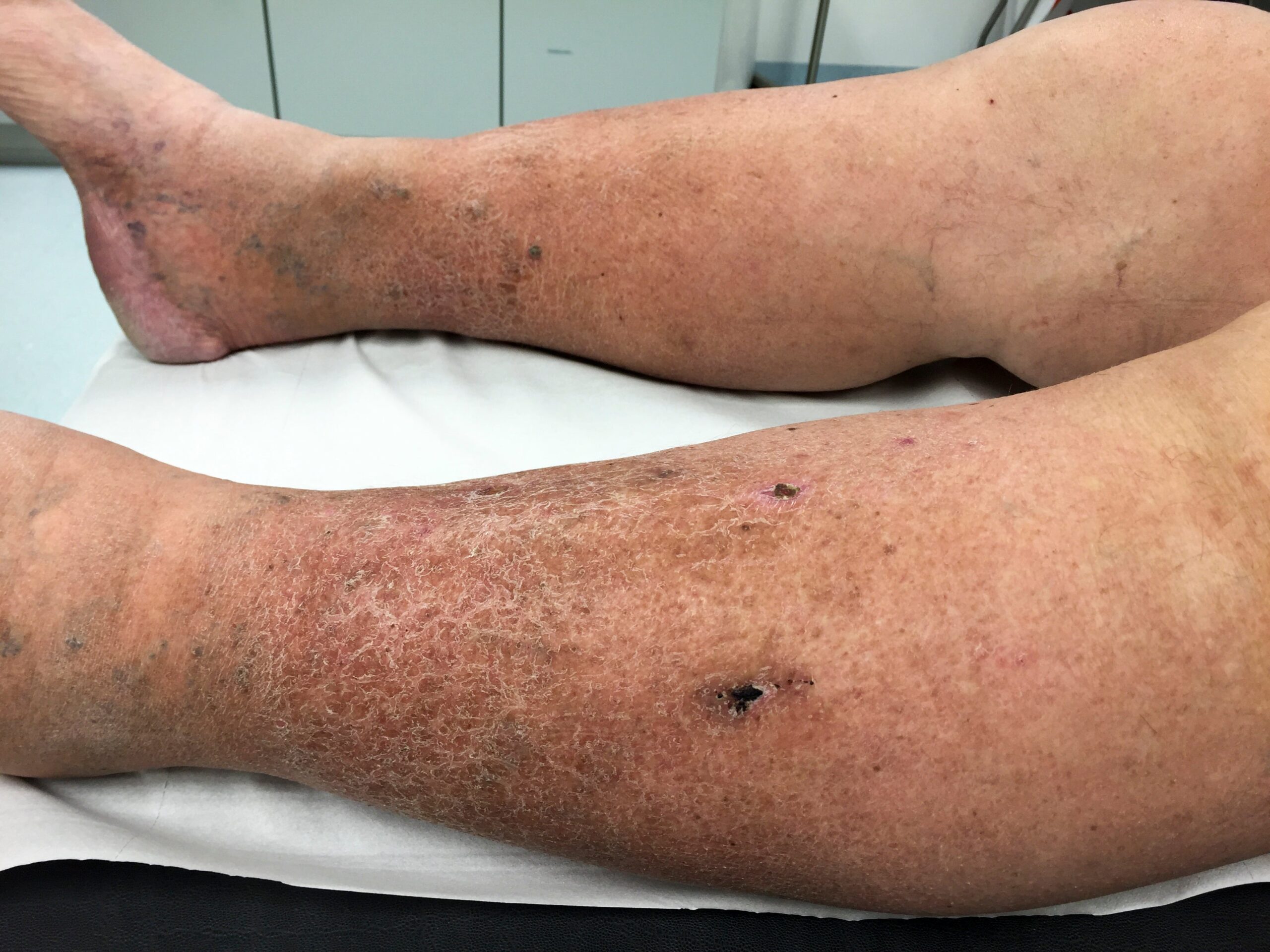 skin changes due to chronic venous insufficiency