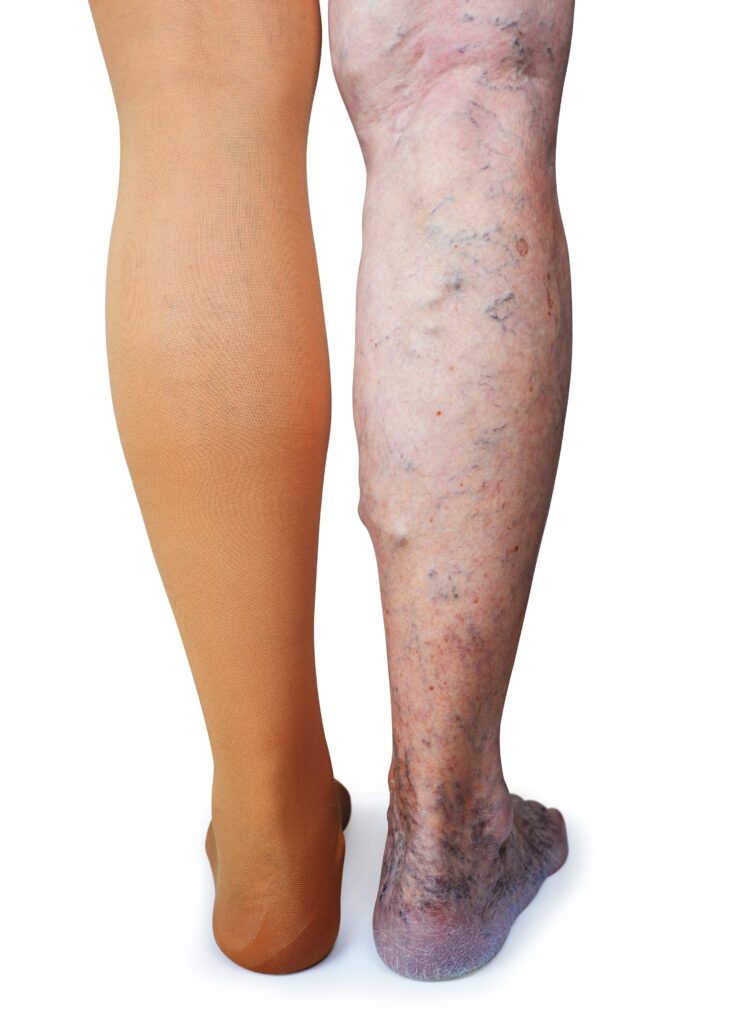 old man with compression stocking due to varicose veins