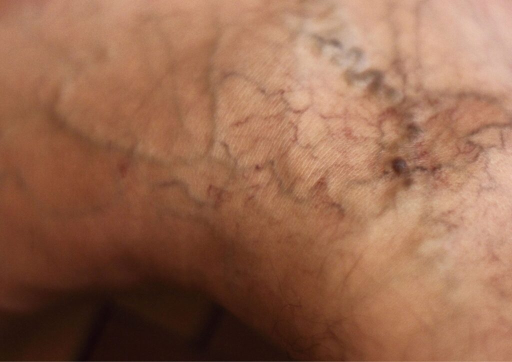spider veins behind the knee