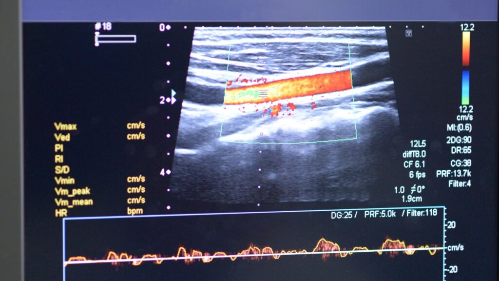 duplex ultrasound scan
