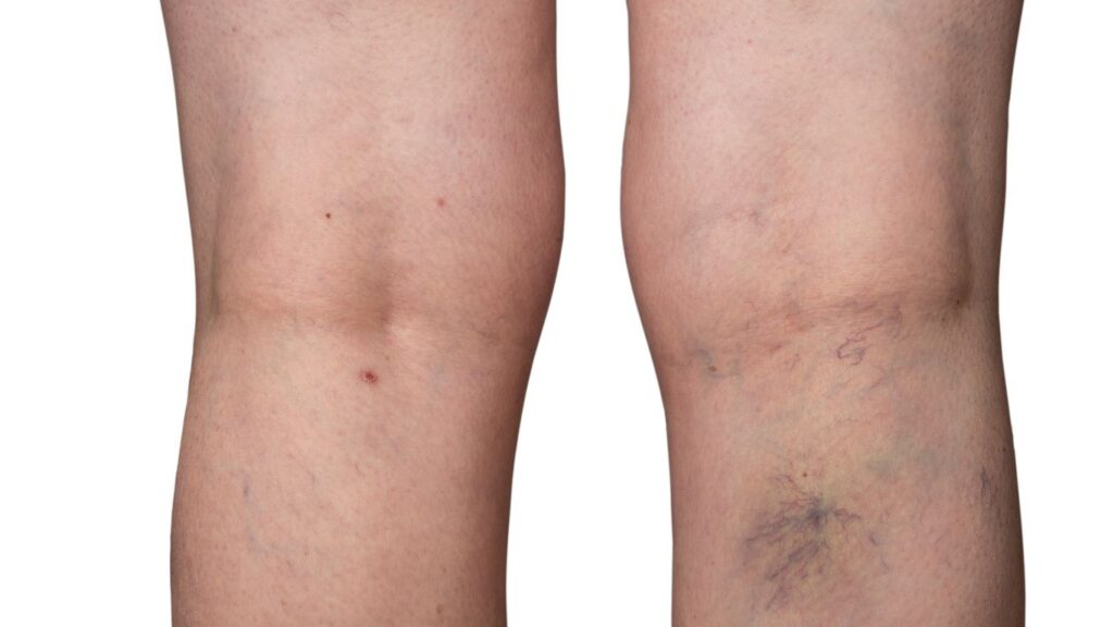 spider veins looking like a bruise on the legs
