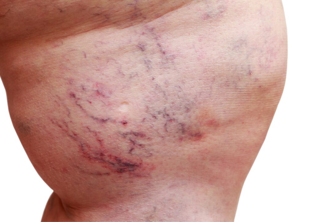 spider veins inside the thigh