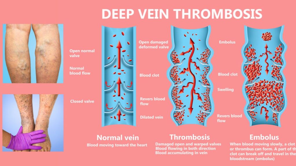 deep venous thrombosis cartoon