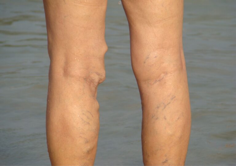 varicose veins right leg