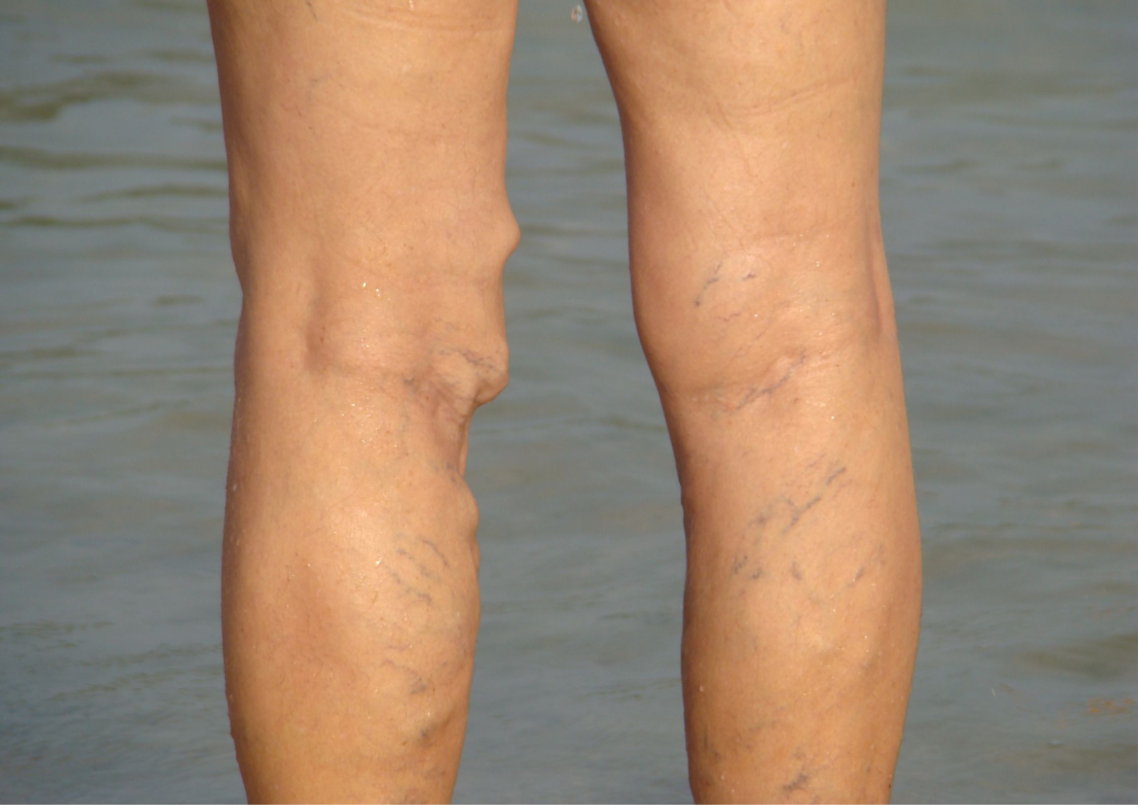 varicose veins right leg