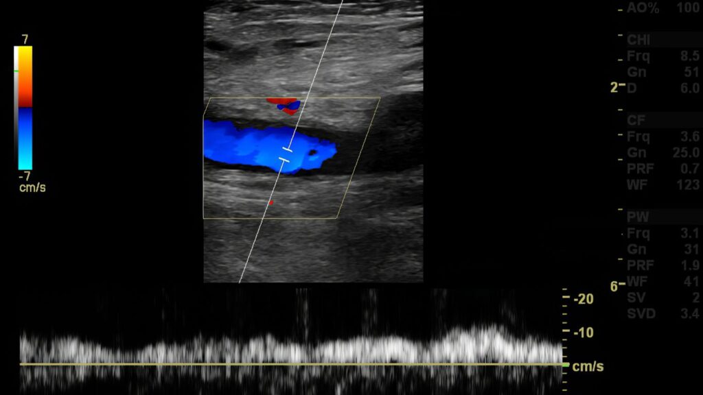 ultrasound of DVT