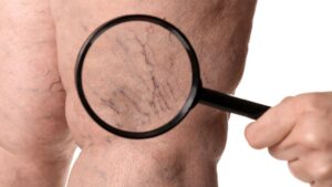 How is chronic venous insufficiency diagnosed?