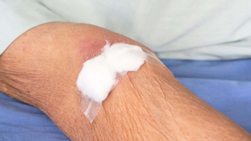 pressure point to prevent bleeding post phlebotomy