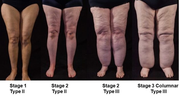 Different Stages of Lipoedma