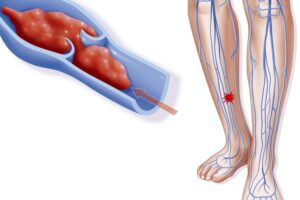 post-thrombotic-syndrome