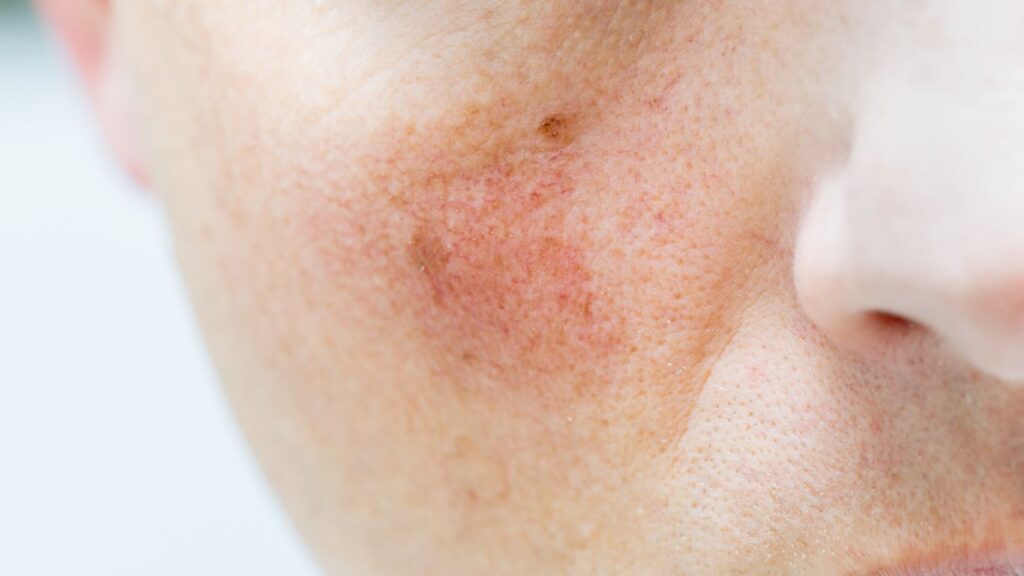 spider veins and facial flush on the right cheek