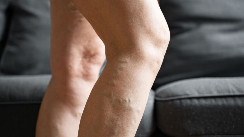 varicose veins on right leg