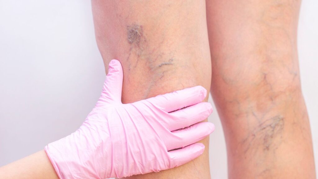 varicose veins on legs being investigated