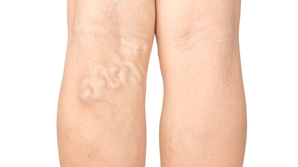 varicose veins back of the left leg