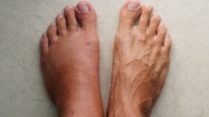 left swollen foot