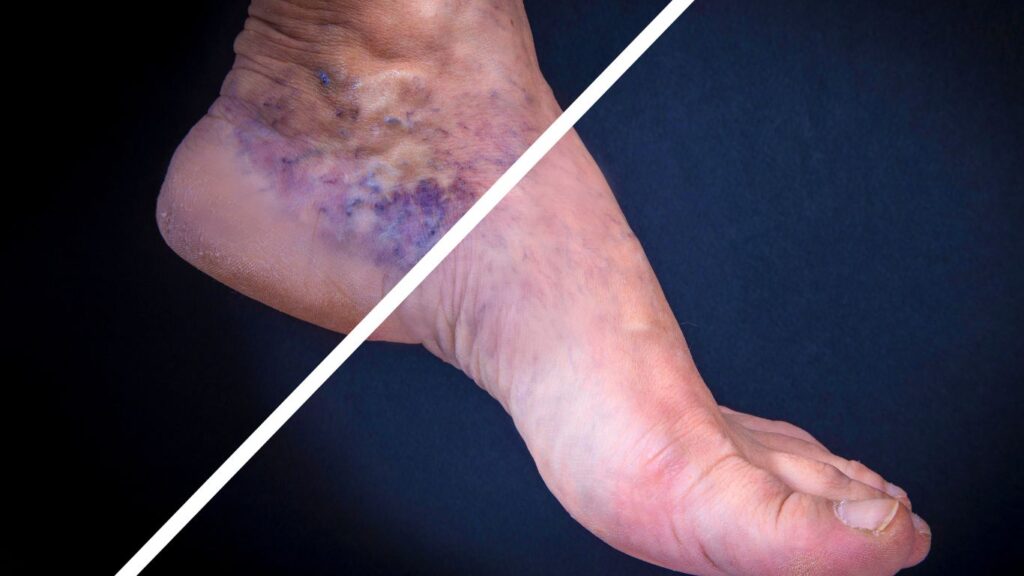 before after veins ankle