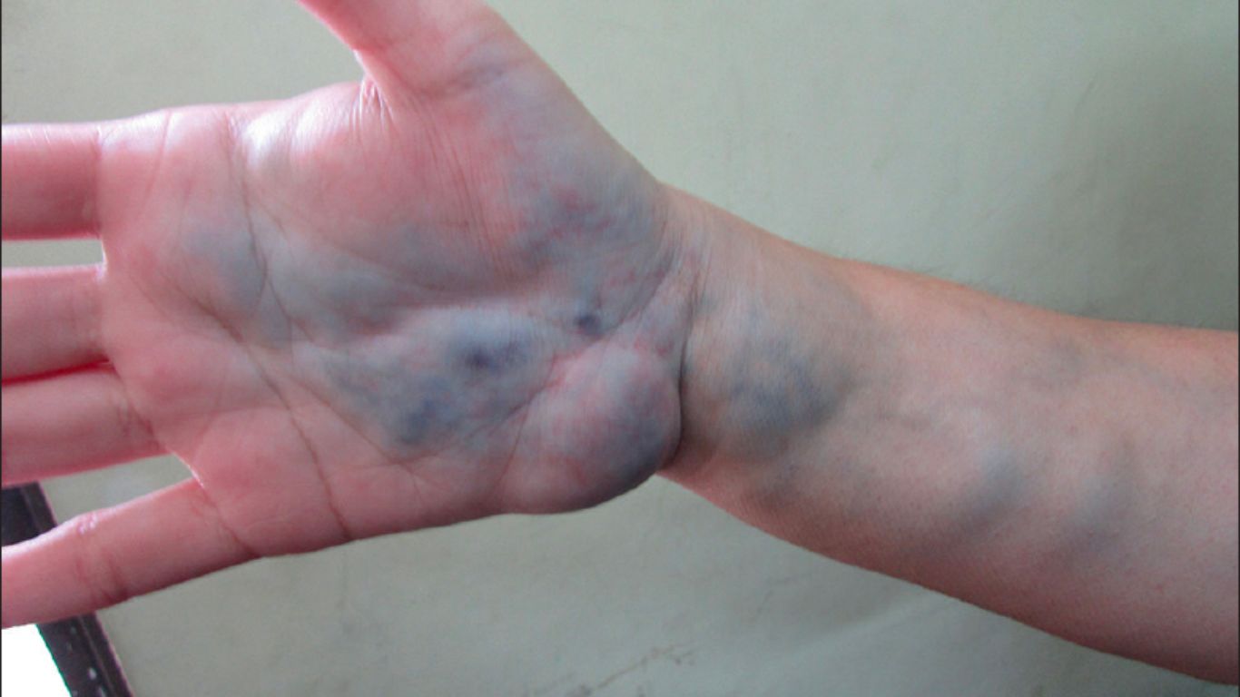 venous malformation hand