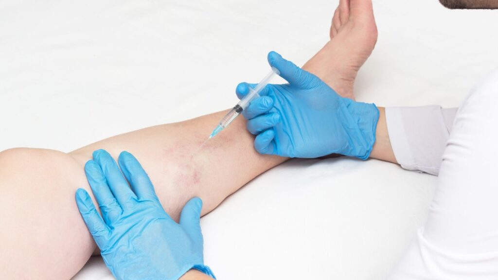 sclerotherapy lower leg