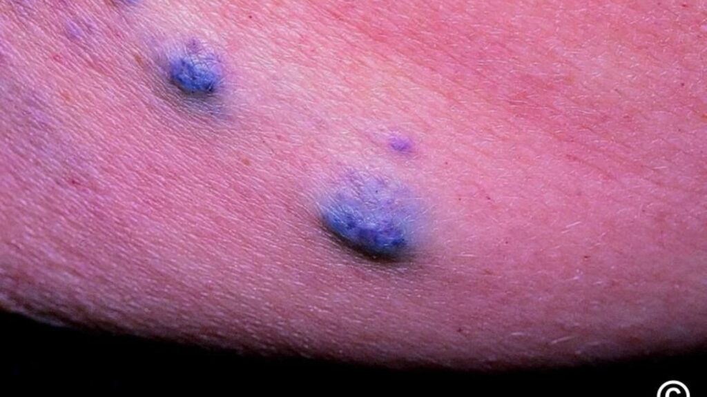 signs of blue rubber blebs syndrome
