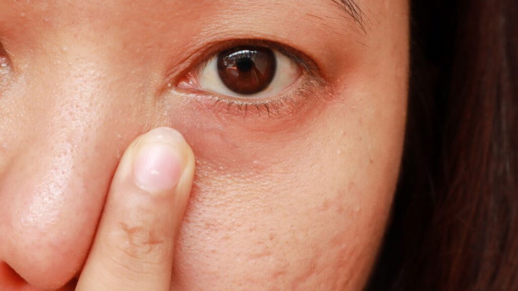 patient pointing out a periorbital vein under her left eye