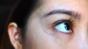 vein under right eye