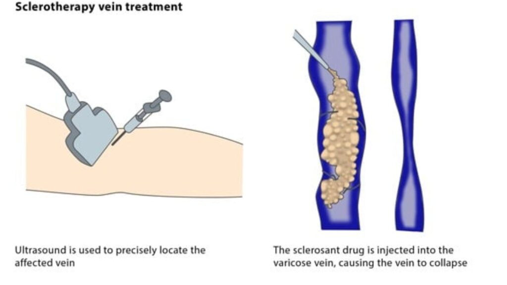 sclerotherapy mechanism