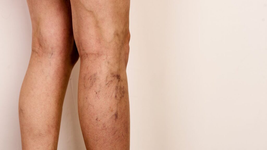 spider veins over the leg