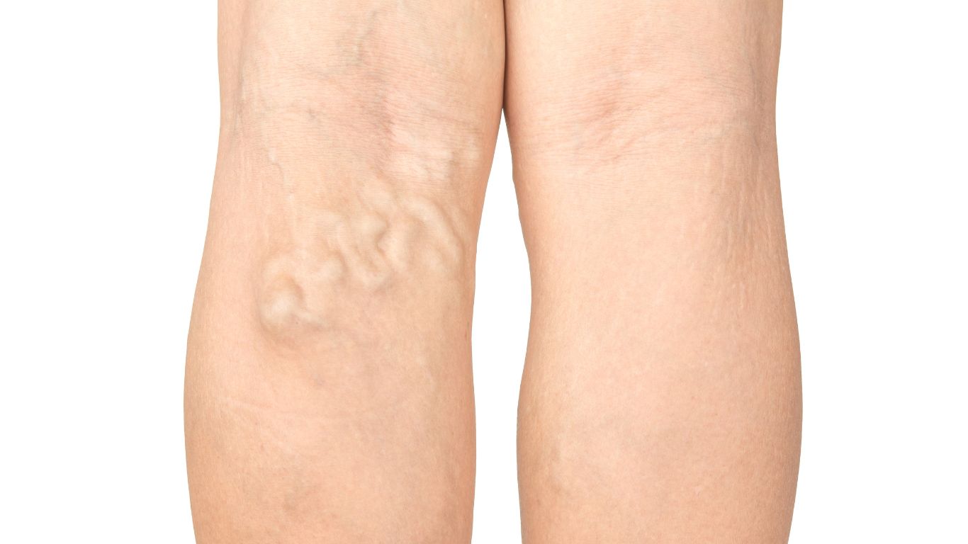 varicose veins left back of the leg