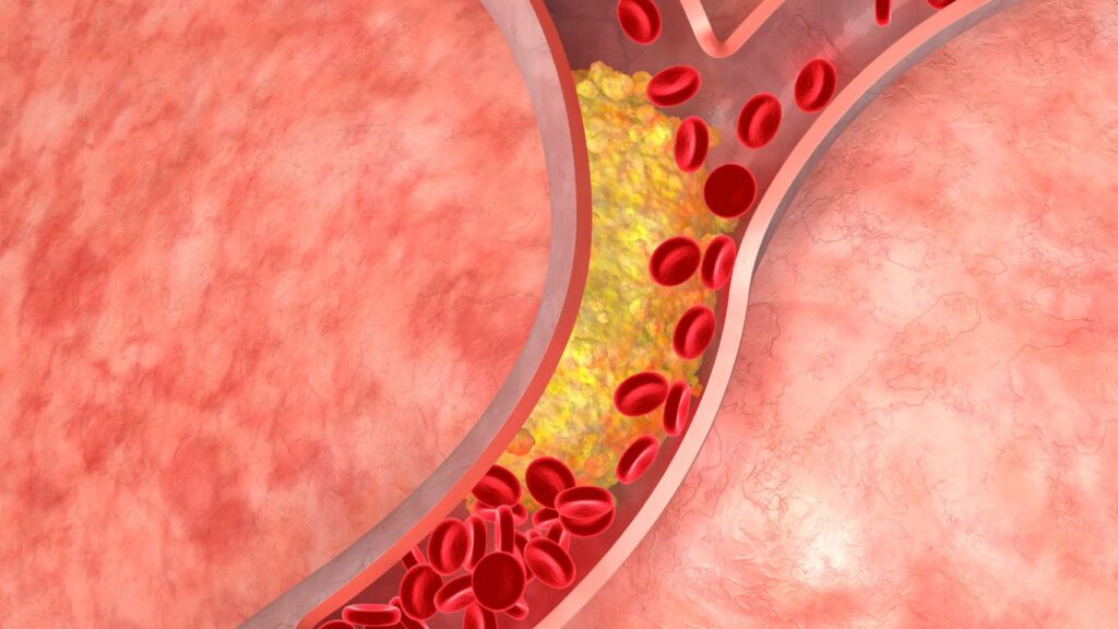 atherosclerosis