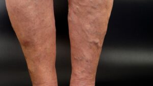 symptoms of varicose veins